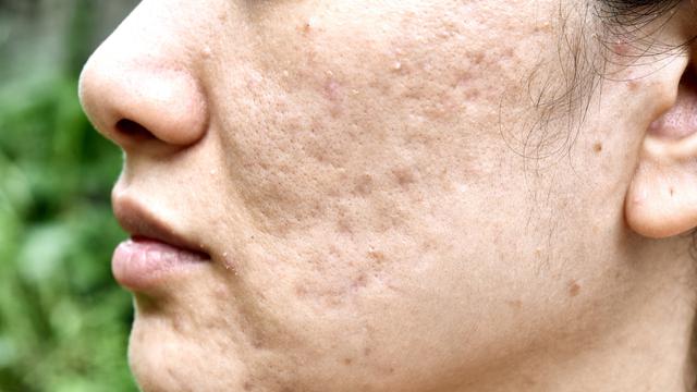 Cara Menghilangkan Bopeng Bekas Jerawat dengan Bahan Alami, Ampuh Banget -  Hot Liputan6.com