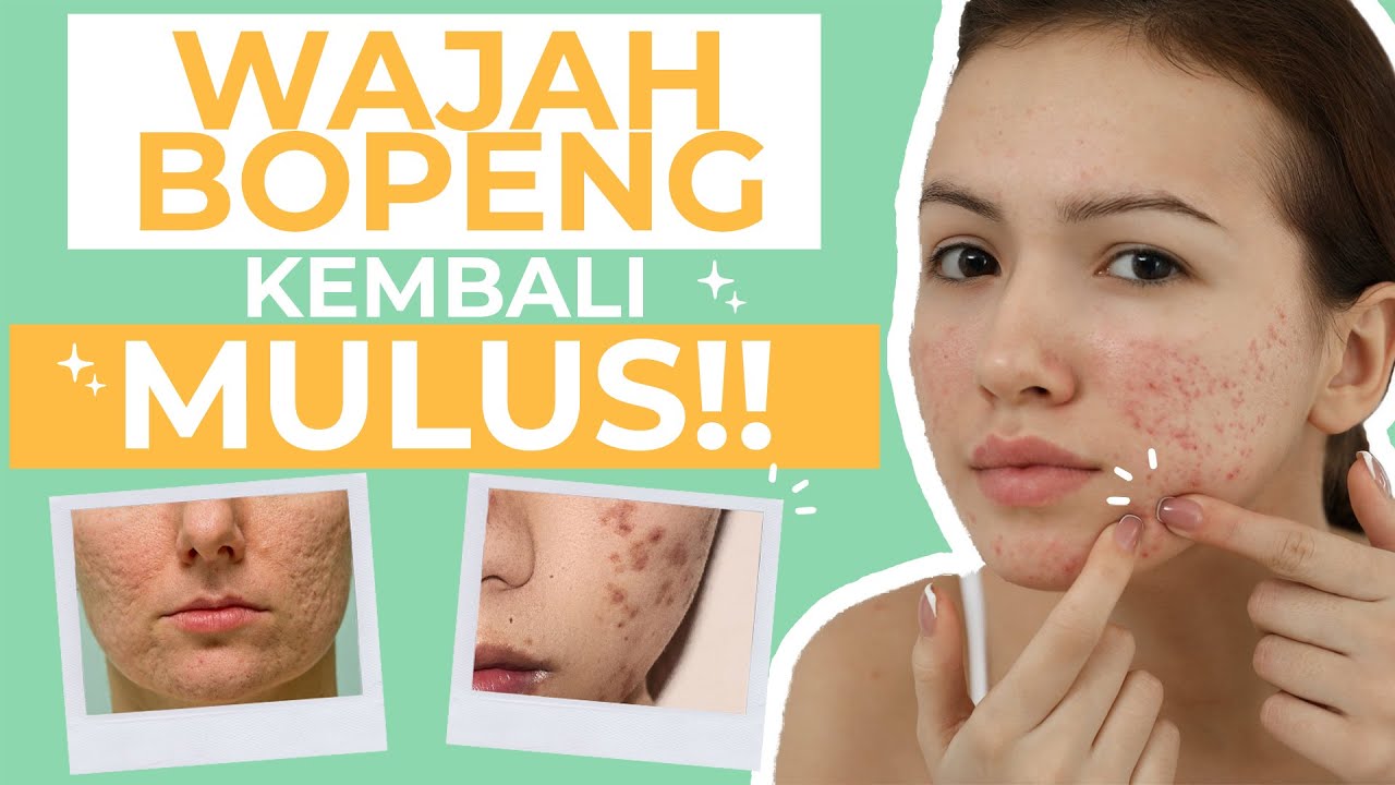 Murah Meriah! 5 Cara Menghilangkan Bopeng Bekas Jerawat Alami dan Cepat! -  YouTube